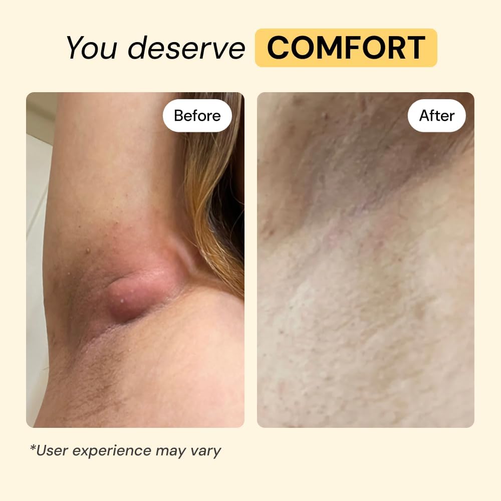 MyMagicHealer Universal Flare Care ‰ÛÒ Multi-Purpose Solution | Skin Flare-Ups - Hidradenitis Suppurativa, Folliculitis, Boils, Cysts | Anti-Chafing | Irritated Skin Relief w/Propolis & Egg Yolk 1 oz