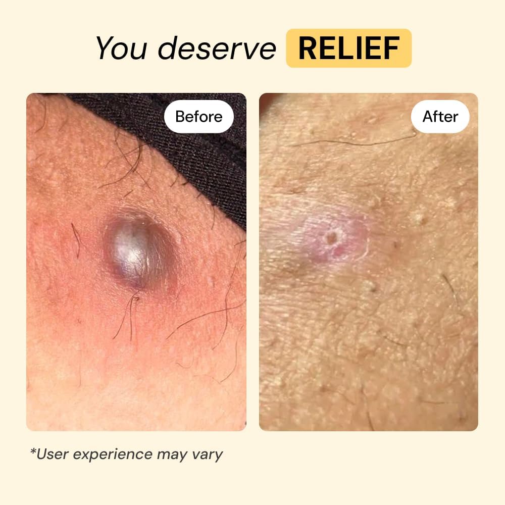 MyMagicHealer Universal Flare Care ‰ÛÒ Multi-Purpose Solution | Skin Flare-Ups - Hidradenitis Suppurativa, Folliculitis, Boils, Cysts | Anti-Chafing | Irritated Skin Relief w/Propolis & Egg Yolk 1 oz